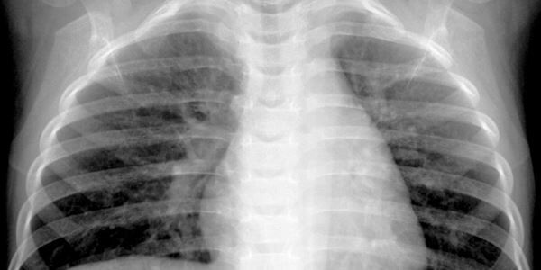 A new virus is spreading in China
