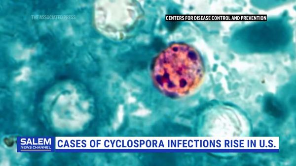 Experts Urge Awareness, Hygiene Habits Amid Cyclospora Outbreak In U.S.