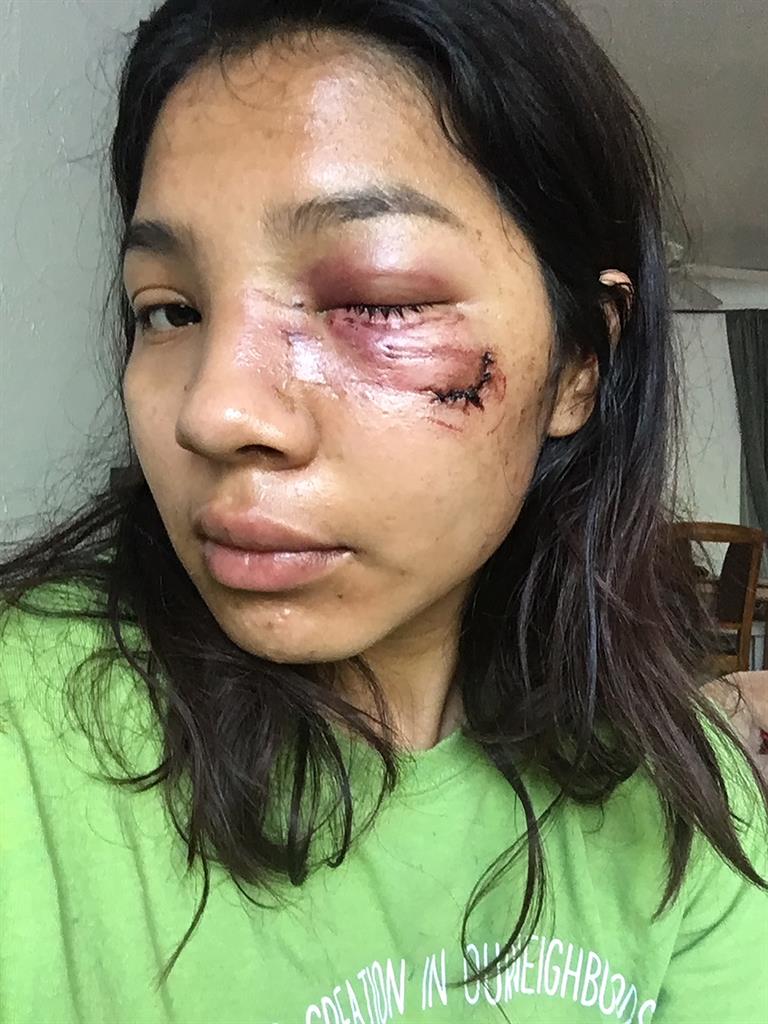 This undated photo provided by Graciela Cisneros shows Cisneros after being injured May, 29, 2020, by a police projectile in violent protests that followed the death of George Floyd in Minneapolis. The city of Minneapolis has settled the first lawsuit by Cisneros, a demonstrator injured in the protests. Cisneros will receive a payment of $57,900 for injuries to her face when a police officer fired a non-lethal round at her as she walked home from a demonstration. Cisneros' cheekbone was broken and her injury required stitches. She was not arrested. (Graciela Cisneros via AP)